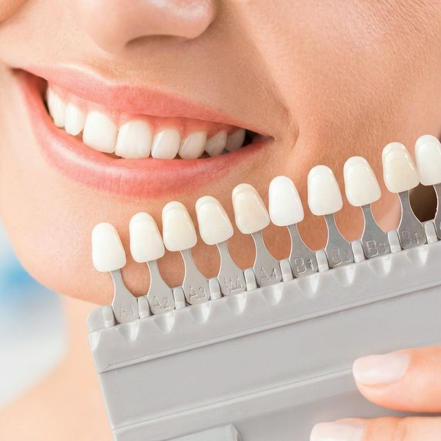 Professionelles Bleaching